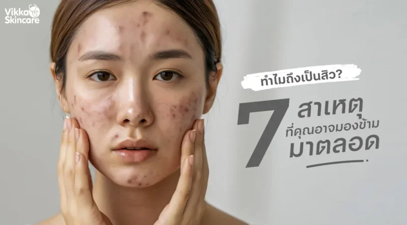 ทำไมถึงเป็นสิว? 7 สาเหตุที่คุณอาจมองข้ามมาตลอด
