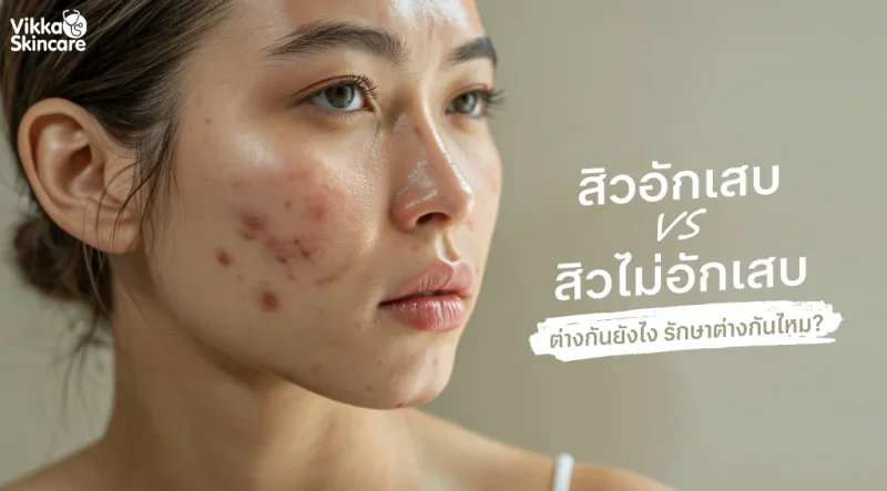 สิวอักเสบ vs สิวไม่อักเสบ ต่างกันยังไง รักษาต่างกันไหม