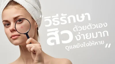 วิธีรักษาสิวด้วยตัวเองง่ายมากดูแลยังไงให้หายตาม Flow นี้ไม่หลุดแน่ !!