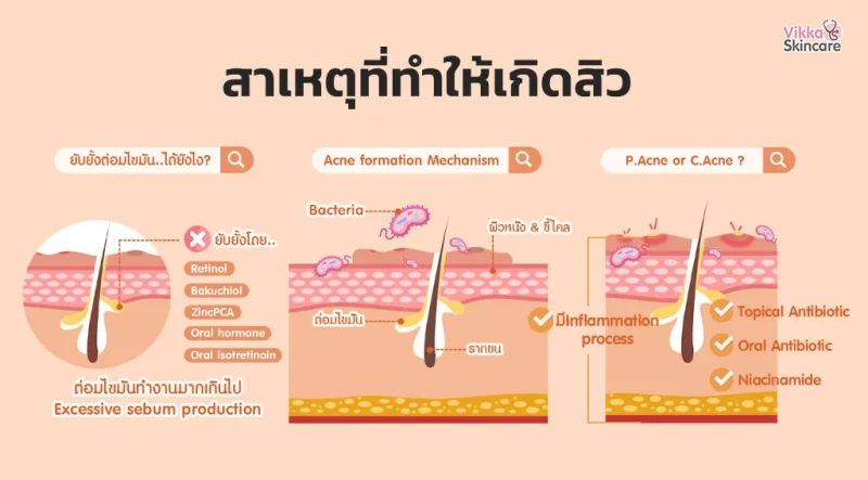 สาเหตุที่ทำให้เกิดสิว ป้องกันอย่างไรดี?