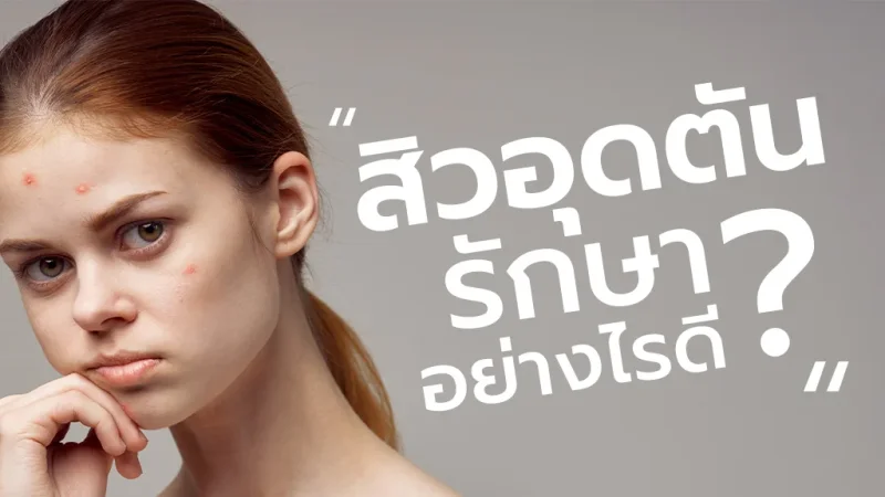 สิวอุดตัน รักษาอย่างไรดี?