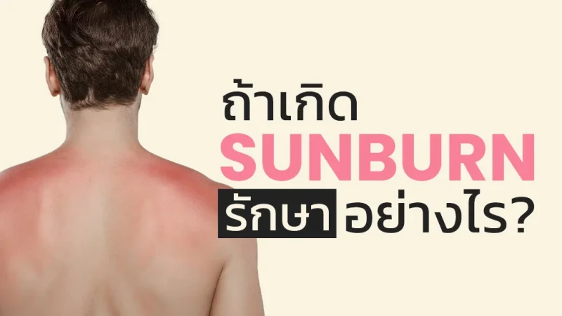 เคล็ดลับดูแลผิวไหม้แดด พร้อมวิธีป้องกันเพื่อสุขภาพผิวที่แข็งแรง