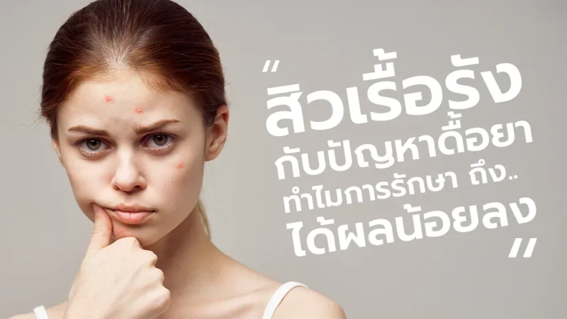 สิวเรื้อรังกับการดื้อยาสิว