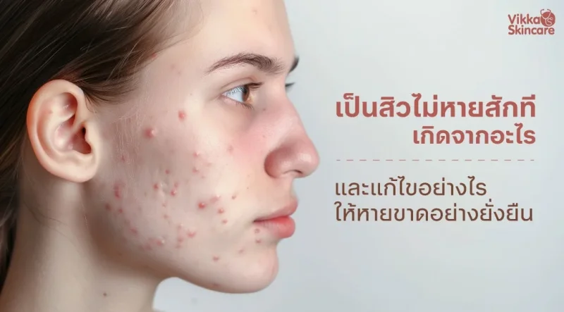 เป็นสิวไม่หายสักที เกิดจากอะไร และแก้ไขอย่างไรให้หายขาดอย่างยั่งยืน