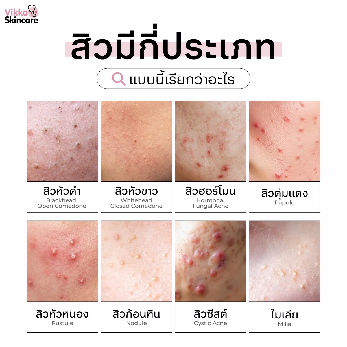 ตารางเปรียบเทียบสิว 8 ประเภทที่พบบ่อย