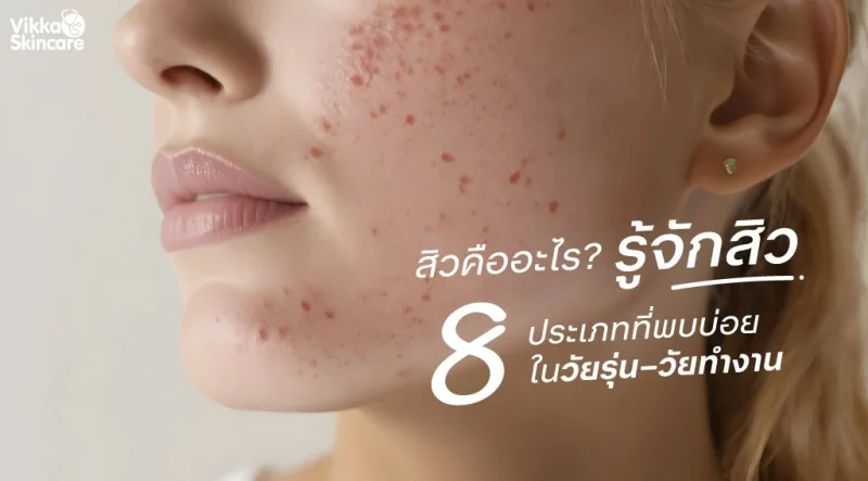 สิวคืออะไร? รู้จักสิว 8 ประเภทที่พบบ่อยในวัยรุ่น–วัยทำงาน
