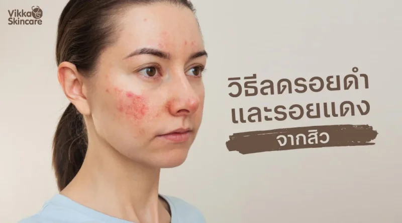 วิธีลดรอยดำและรอยแดงจากสิว (PIH และ PIE) ทำความเข้าใจสาเหตุ และแนวทางดูแลอย่างเป็นระบบ