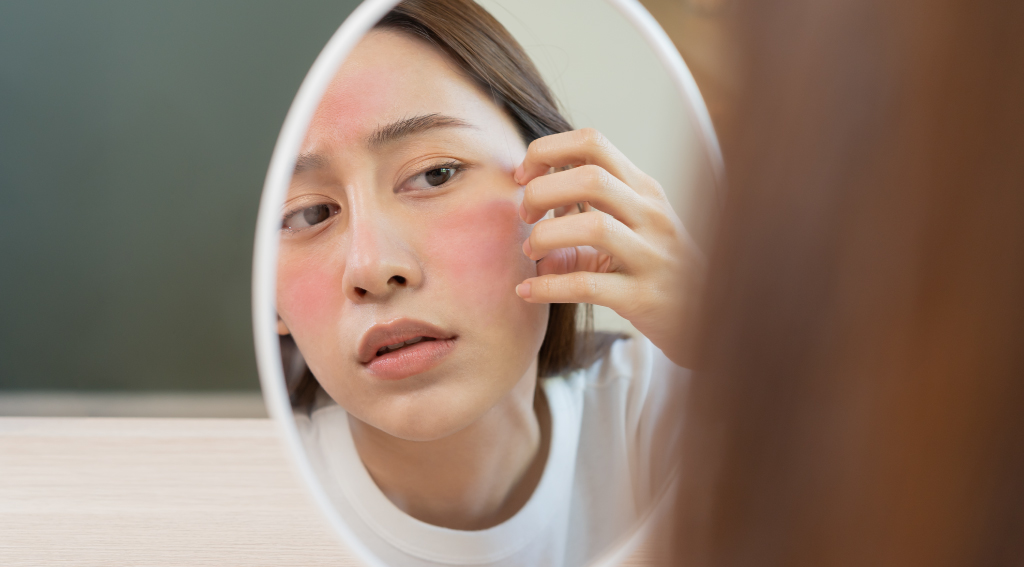 อาการผิวแพ้ง่าย มีรอยแดง และการดูแลผิวบอบบาง